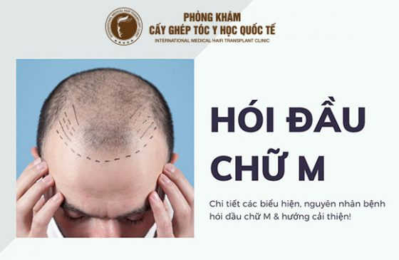 tóc hói chữ m nữ, tóc hói chữ m nam, cấy tóc hói chữ m, cấy tóc hói chữ m giá bao nhiêu, tóc bị hói chữ m, tóc mái hói chữ m nam, tóc cho hói chữ m, chữa tóc hói chữ m, tóc hói chữ m, đường chân tóc chữ m,