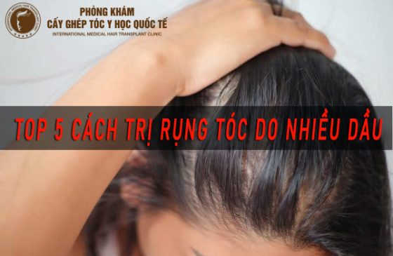 cách trị rụng tóc do nhiều dầu