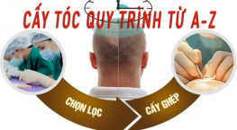 Cấy tóc quy trình có phức tạp không? Có gây đau đớn không?