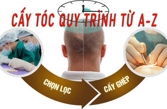 cấy tóc quy trình