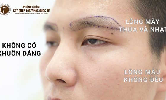 cấy lông mày cho nam