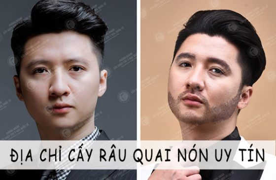 địa chỉ cấy râu quai nón
