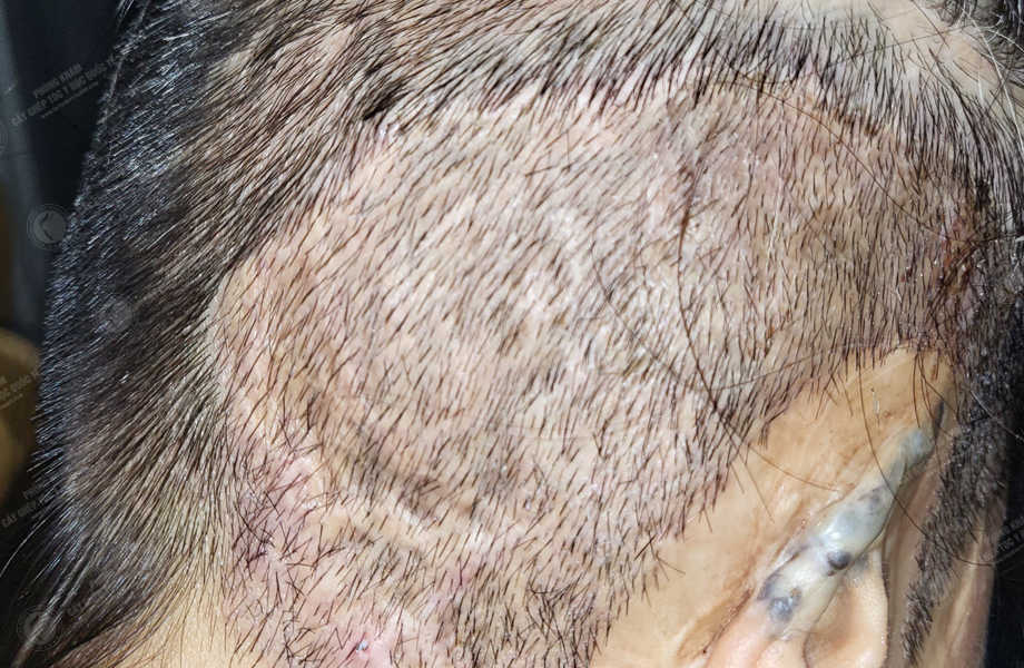 Trần Thu Ngân - Cấy tóc trên sẹo 11