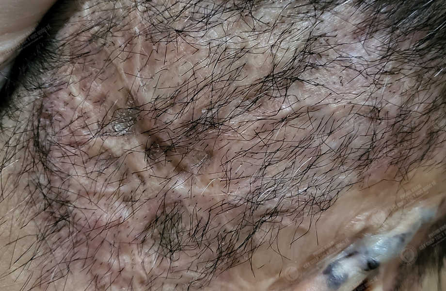 Trần Thu Ngân - Cấy tóc trên sẹo 12