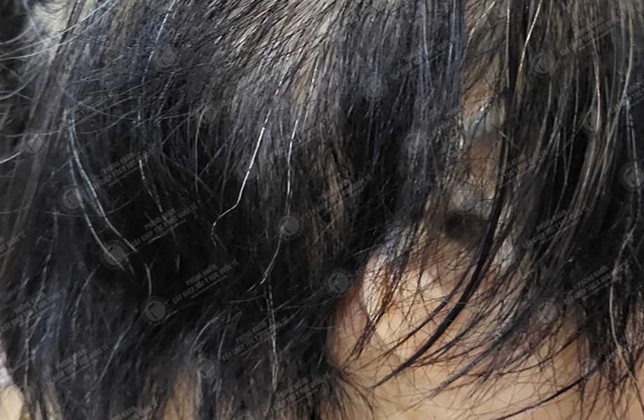 Trần Thu Ngân - Cấy tóc trên sẹo 13