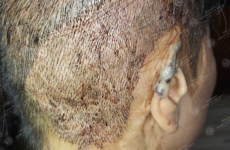 Trần Thu Ngân - Cấy tóc trên sẹo 10