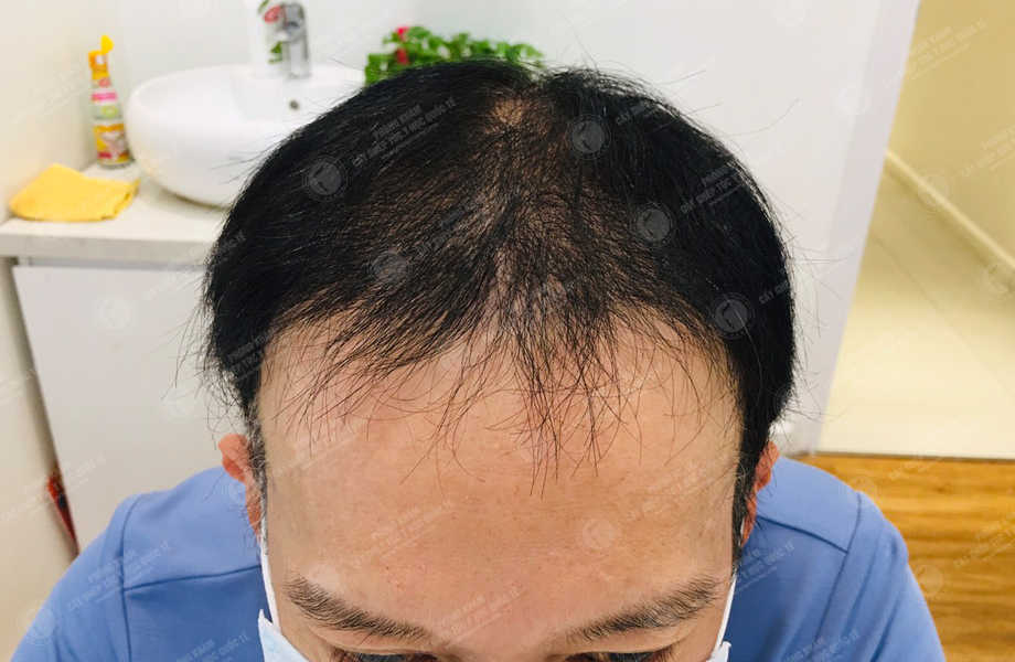 Đỗ Việt Hùng - Cấy tóc đường chữ M 15