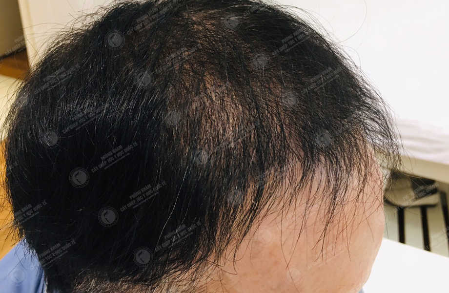 Đỗ Việt Hùng - Cấy tóc đường chữ M 16