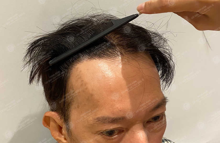 Đỗ Việt Hùng - Cấy tóc đường chữ M 17