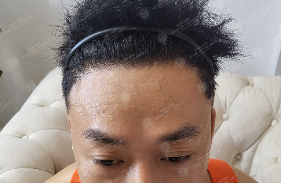 Ca sĩ Dương Tôn - Cấy tóc đường chữ M 16