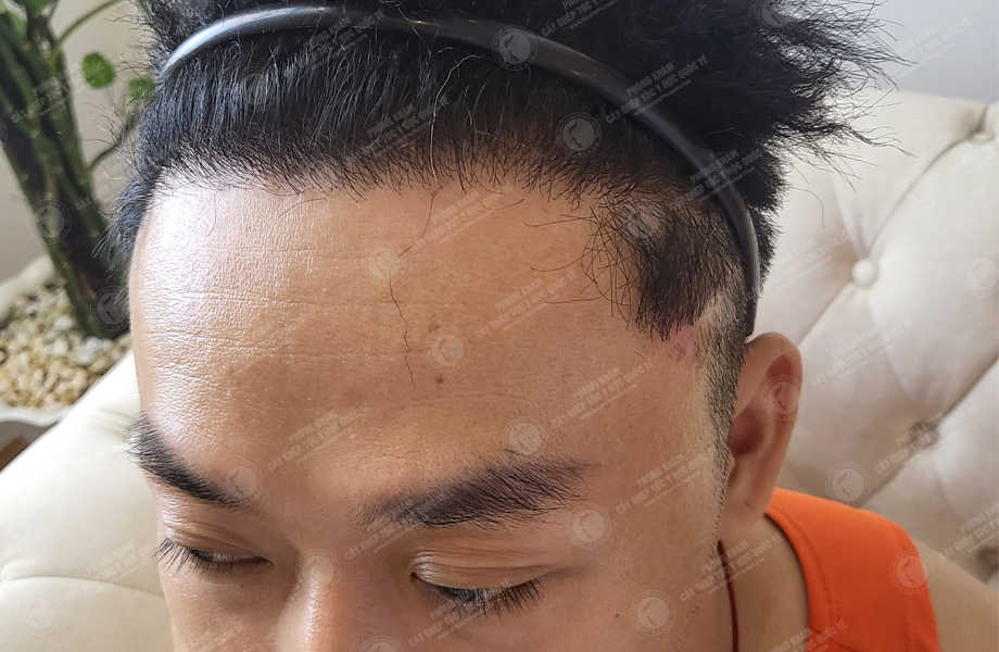Ca sĩ Dương Tôn - Cấy tóc đường chữ M 17