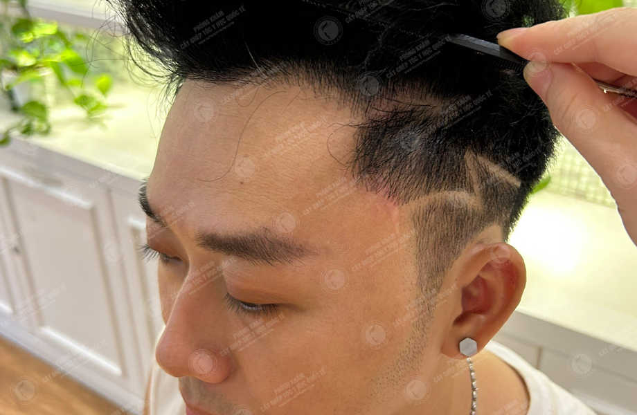 Ca sĩ Dương Tôn - Cấy tóc đường chữ M 18