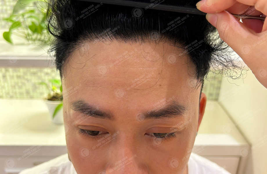 Ca sĩ Dương Tôn - Cấy tóc đường chữ M 20