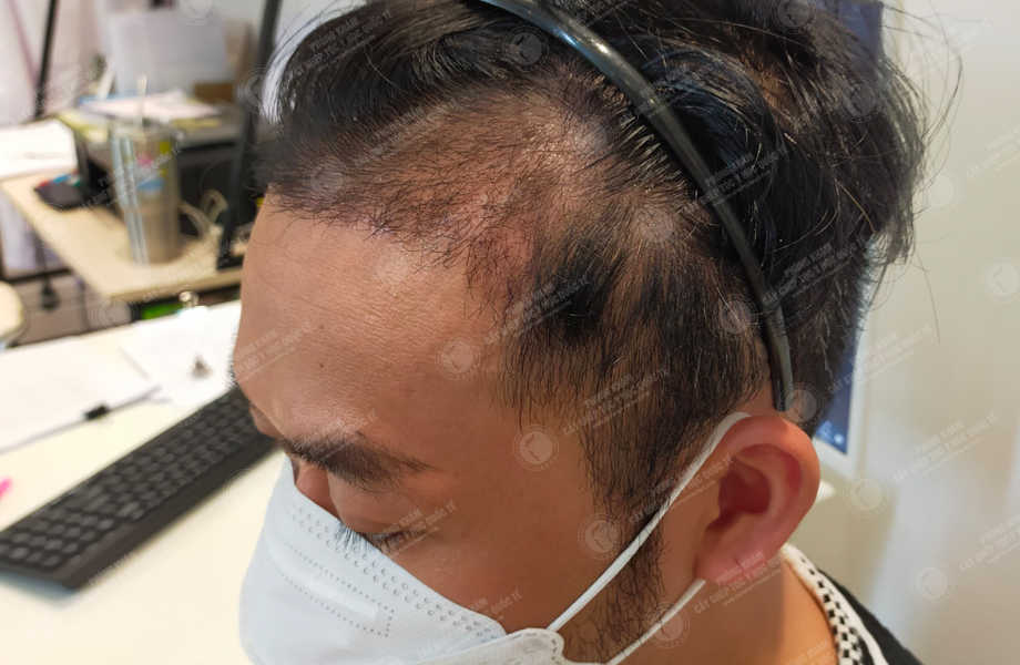 Ca sĩ Dương Tôn - Cấy tóc đường chữ M 8