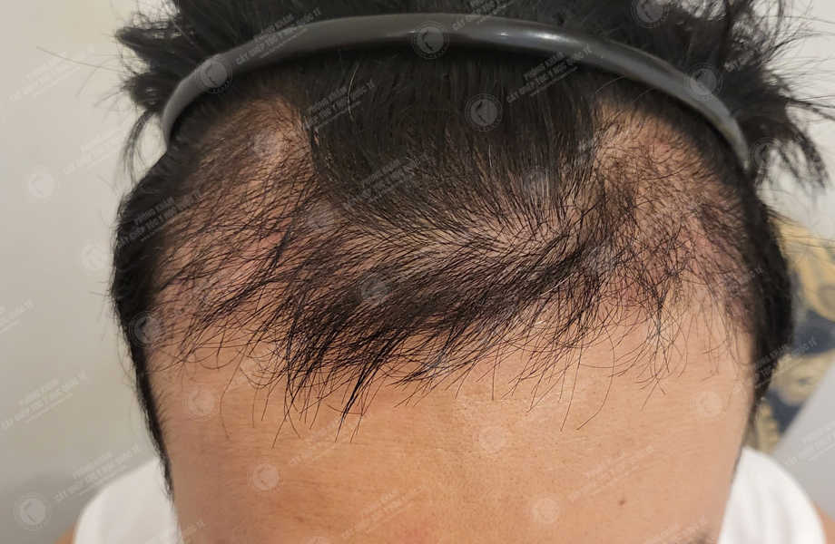 Ca sĩ Dương Tôn - Cấy tóc đường chữ M 9