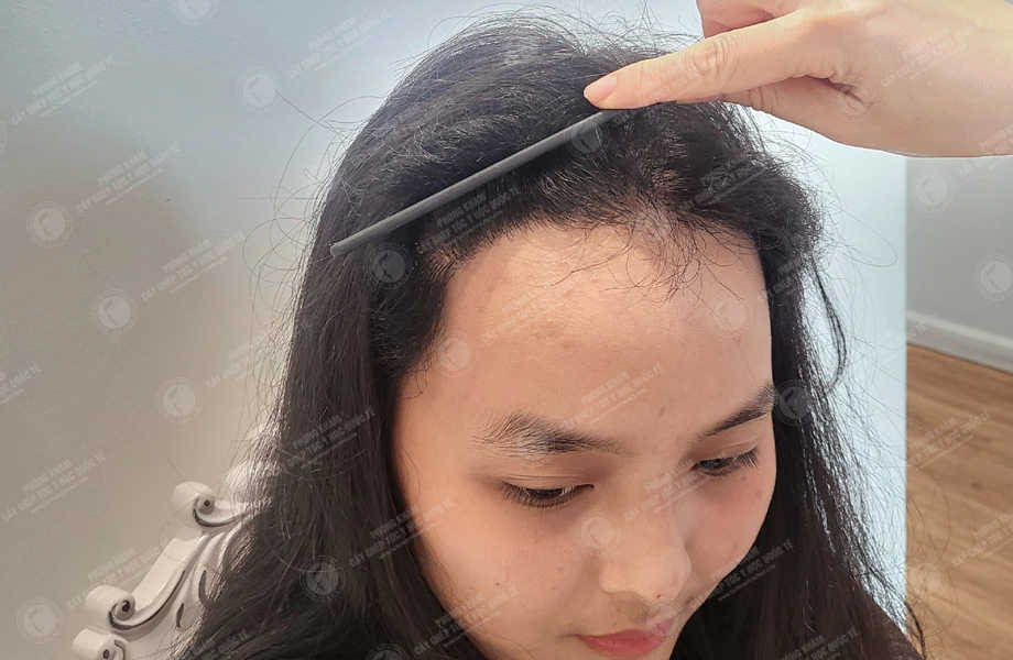 Huỳnh Ngọc Nhi - Cấy tóc tự thân 15