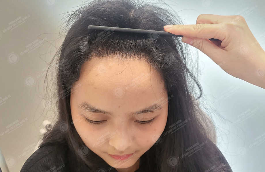 Huỳnh Ngọc Nhi - Cấy tóc tự thân 16
