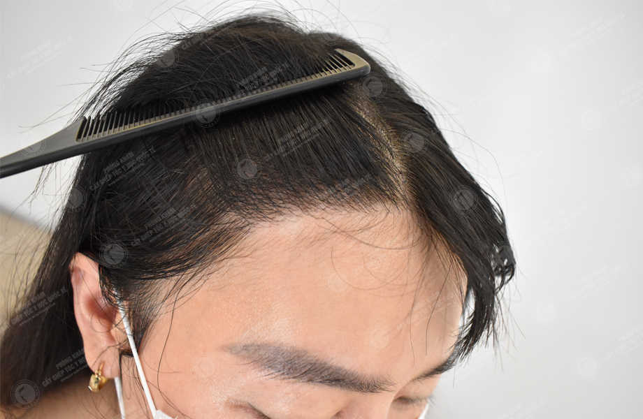 Nguyễn Hồng Quyên - Cấy tóc đường chữ M 17