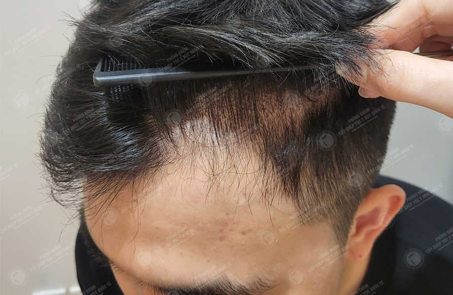 Ngô Thanh Sơn - Cấy tóc đường chữ M 18