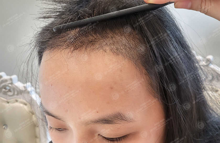 Huỳnh Ngọc Nhi - Cấy tóc tự thân 10