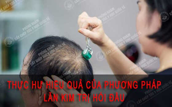 lăn kim trị hói đầu