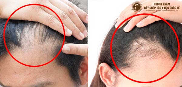 những nguyên nhân gây rụng tóc và cách khắc phục