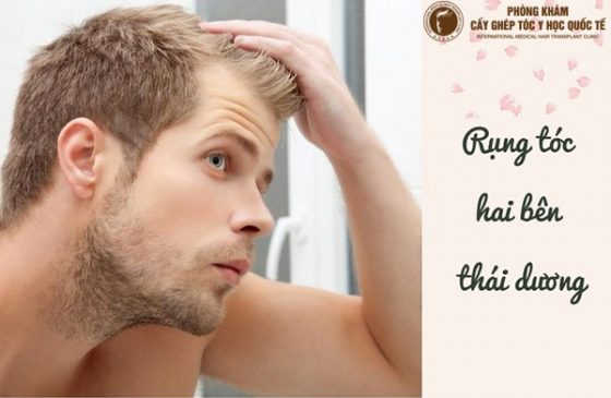 rụng tóc 2 bên thái dương