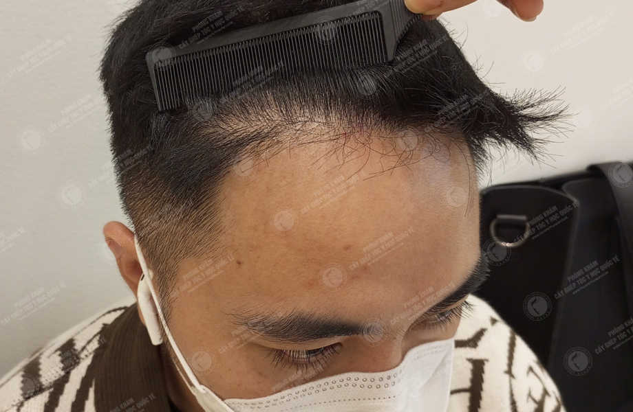 Hà Tấn Cường - Cấy tóc đường chữ M 11