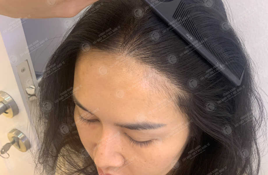 Nguyễn Phương Nhi - Cấy tóc đường chữ M 12