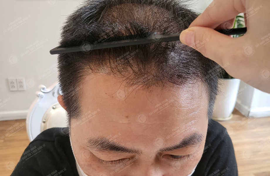 Hoàng Nhất Sơn - Cấy tóc đường chữ M 17