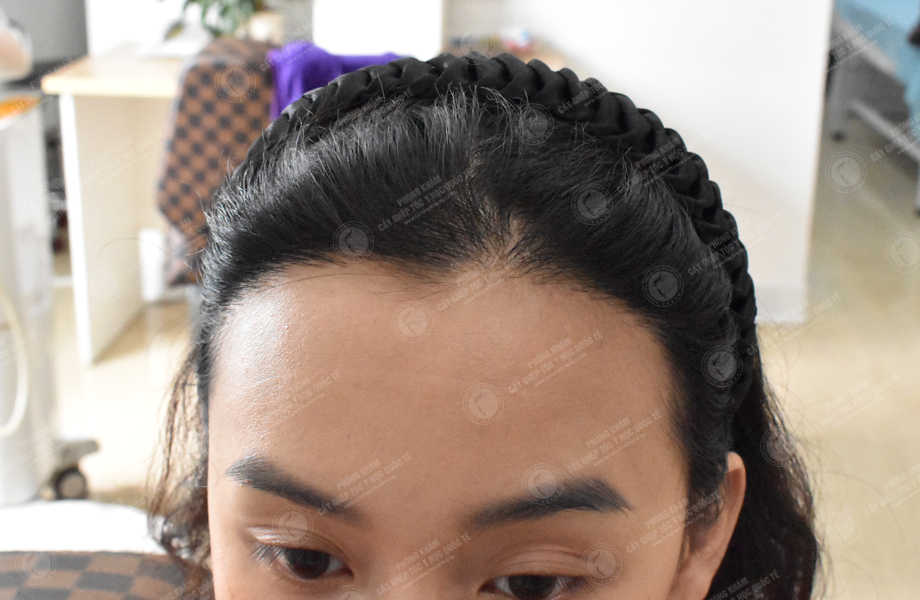 Phạm Phương Lan - Cấy tóc đường chữ M 2