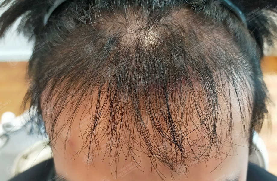 Ngô Viết Sơn - Cấy tóc đường chữ M 10