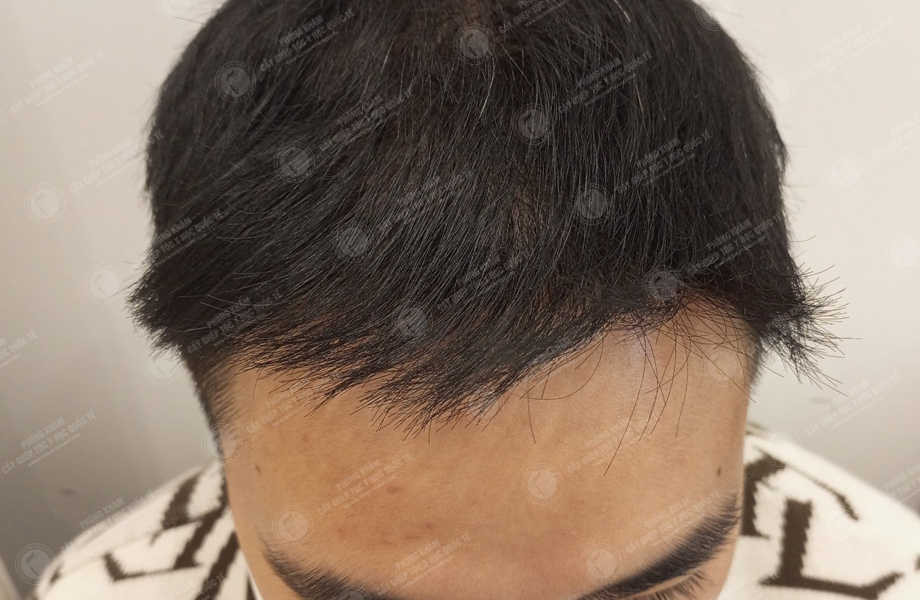 Hà Tấn Cường - Cấy tóc đường chữ M 10