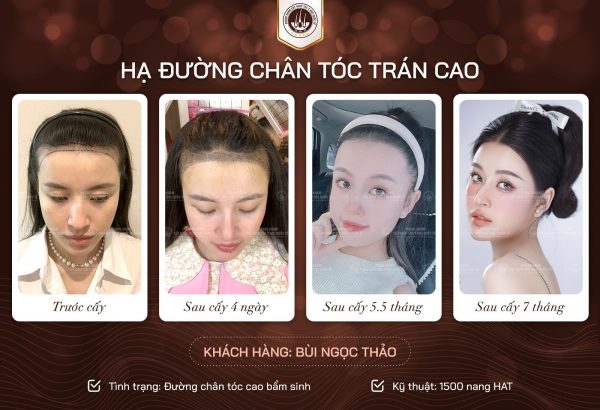 cấy tóc tự thân có vĩnh viễn không