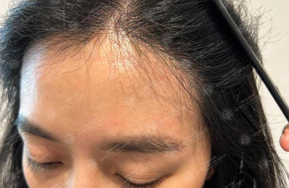 Nguyễn Ngọc Phương - Cấy tóc đường chữ M 12