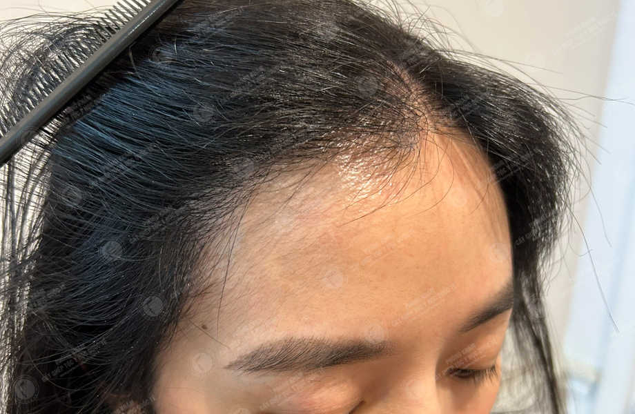 Nguyễn Ngọc Phương - Cấy tóc đường chữ M 13