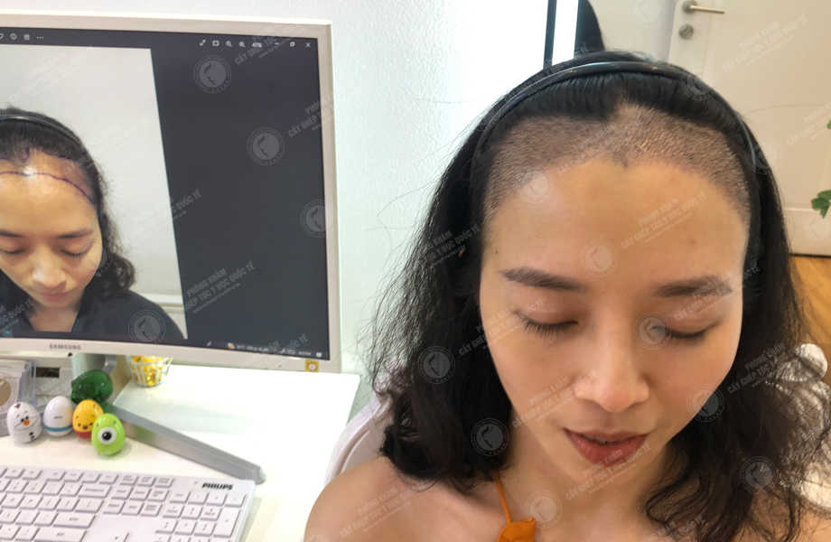 Nguyễn Ngọc Phương - Cấy tóc đường chữ M 7