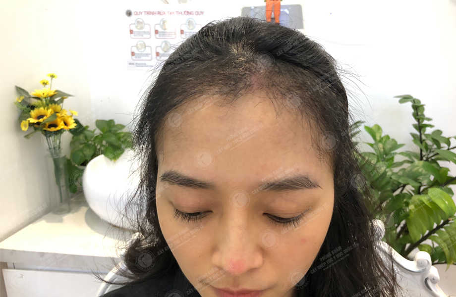 Nguyễn Ngọc Phương - Cấy tóc đường chữ M 10