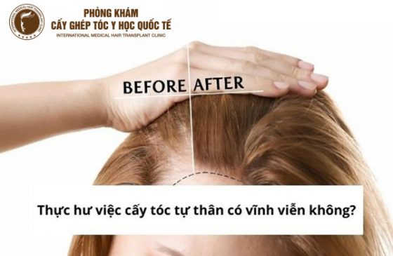 cấy tóc tự thân có vĩnh viễn không