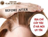 Cấy tóc ở Hà Nội – Review 3 địa chỉ cấy tóc uy tín và chất lượng