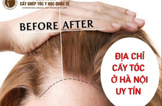 cấy tóc ở Hà Nội