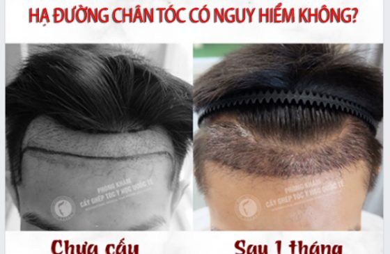 hạ đường chân tóc có nguy hiểm không