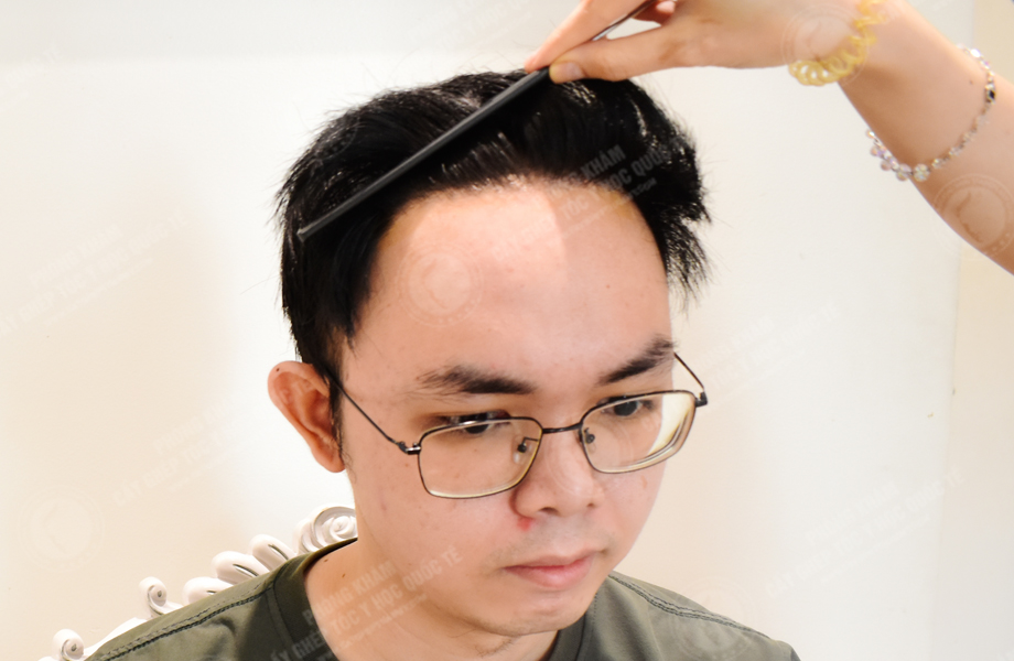 Phan Bảo Long - Cấy tóc đường chữ M 15