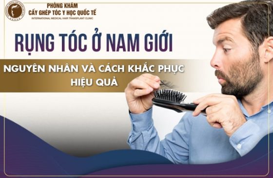 nguyên nhân nam rụng tóc nhiều