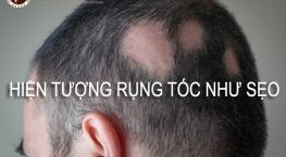 Hiện tượng rụng tóc như sẹo có nguy hiểm không? Lắng nghe chuyên gia giải đáp