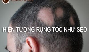 Hiện tượng rụng tóc như sẹo có nguy hiểm không? Lắng nghe chuyên gia giải đáp