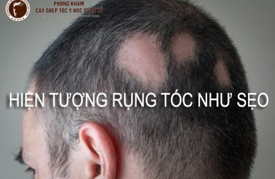 hiện tượng rụng tóc như sẹo