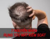 07 Nguyên nhân rụng tóc mất kiểm soát và cách khắc phục tận gốc
