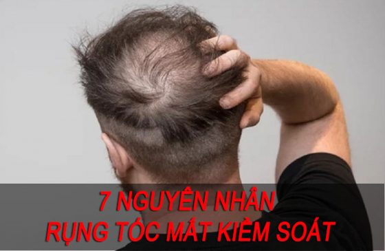 nguyên nhân rụng tóc mất kiểm soát