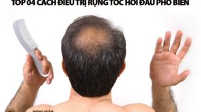 điều trị rụng tóc hói đầu, cách trị rụng tóc hói đầu, cách trị rụng tóc gây hói đầu, cách trị rụng tóc do hói đầu, trị rụng tóc với hói đầu,